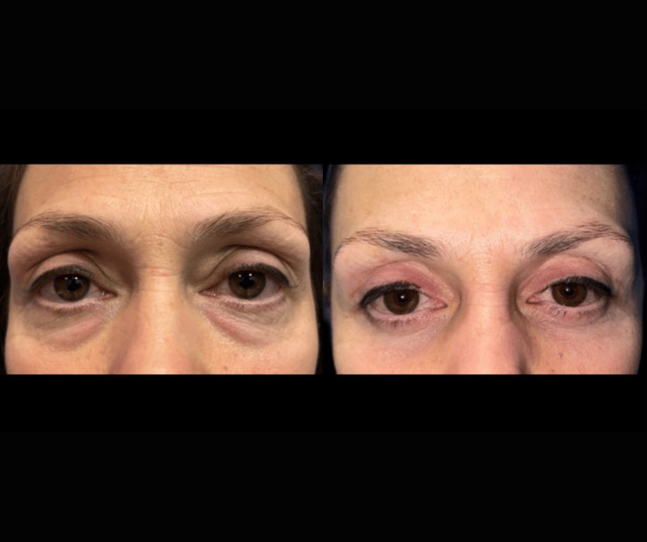 Blepharoplasty Result