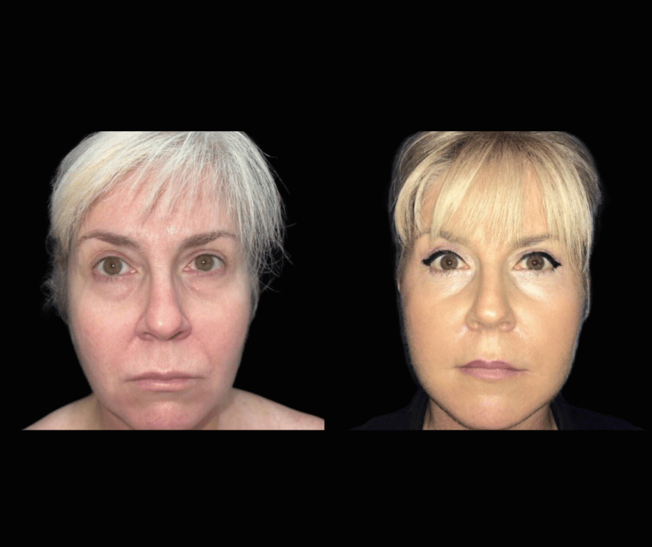 Blepharoplasty Results Dr. Greenberg