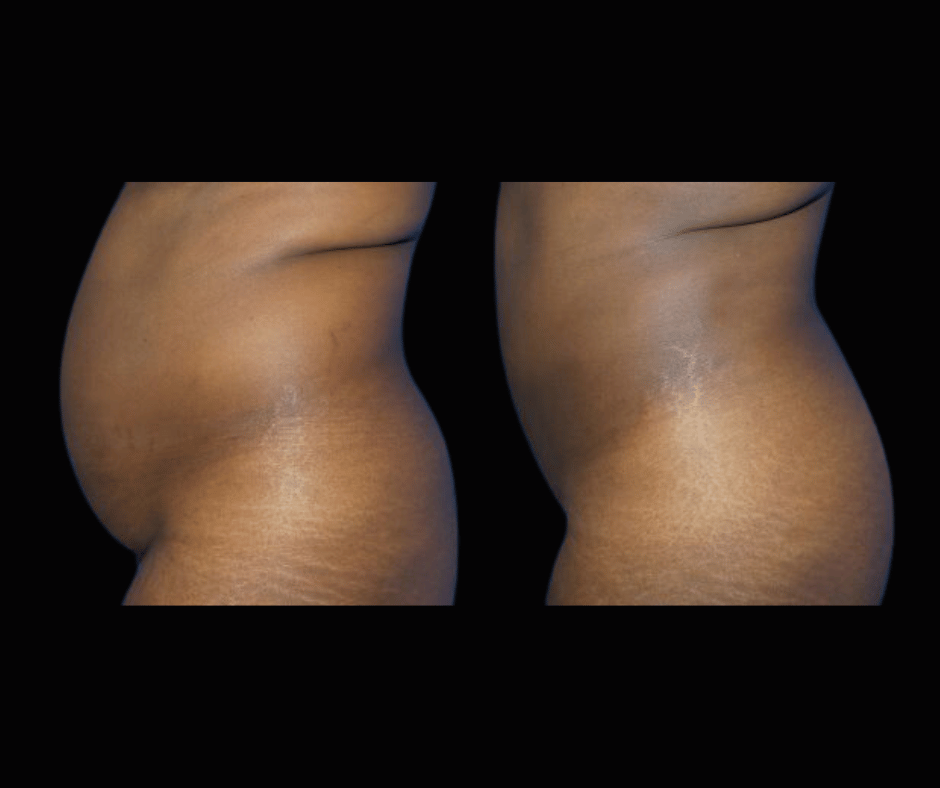 Lipo Results Dr. Greenberg (1)