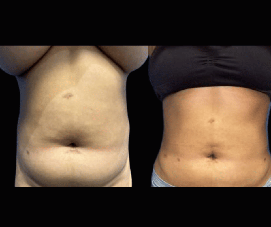 Lipo Results Dr. Greenberg (3)
