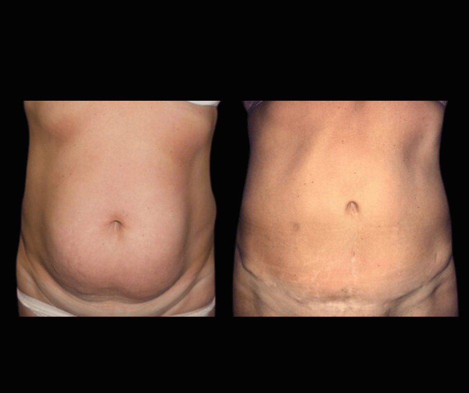 Tummy Tuck Results Dr. Greenberg (2)