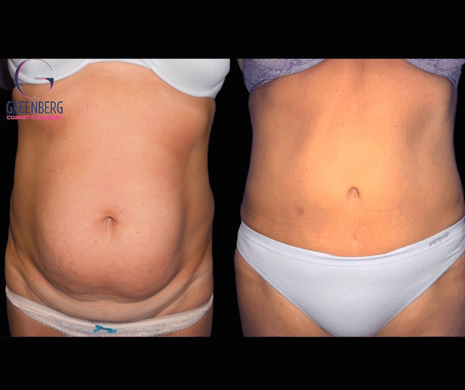 Tummy Tuck Results Dr. Greenberg