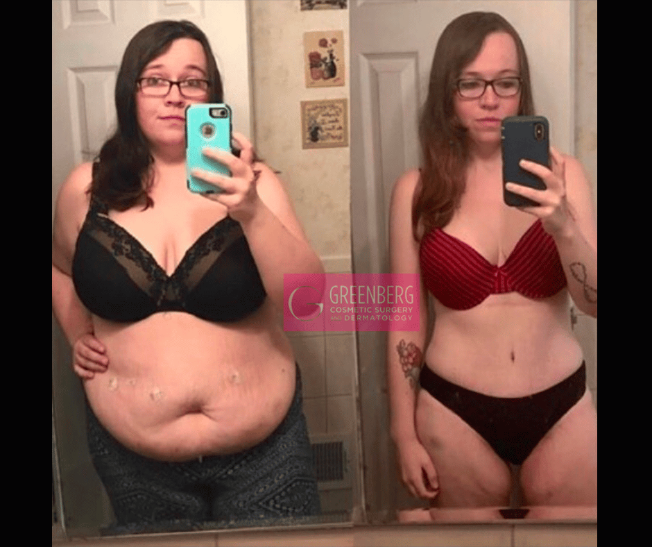 Tummy Tuck Results Dr. Greenberg