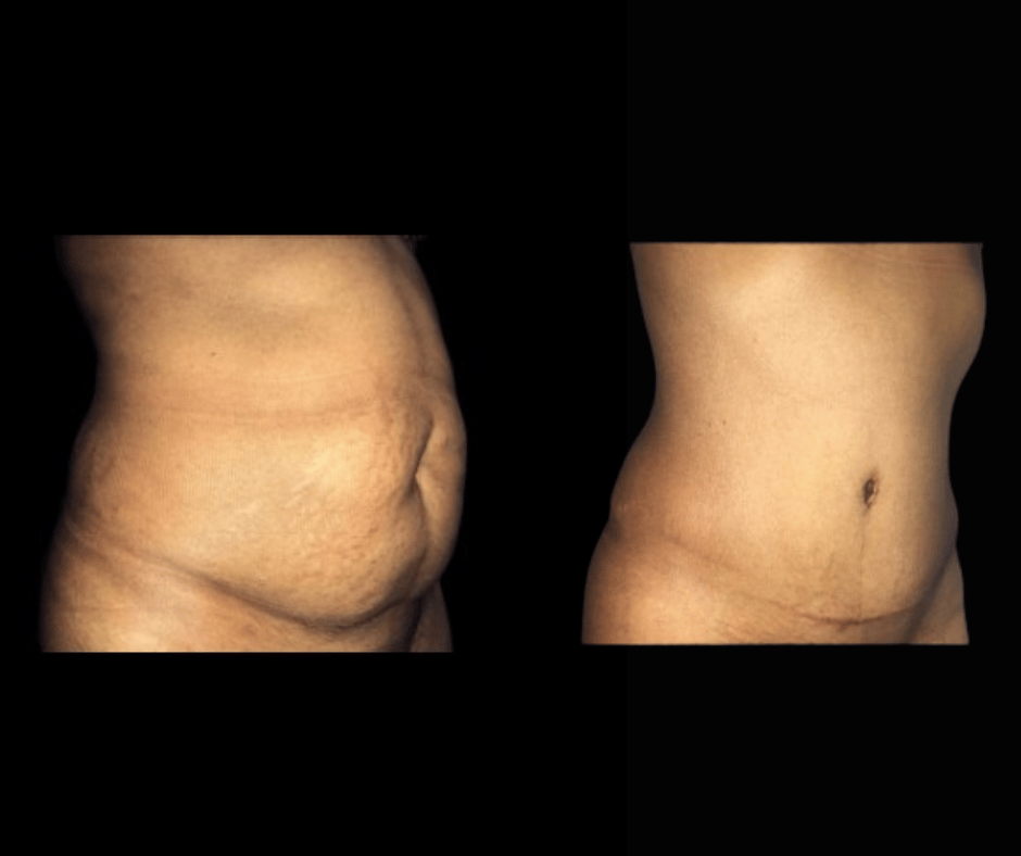 Tummy Tuck Results Dr. Greenberg
